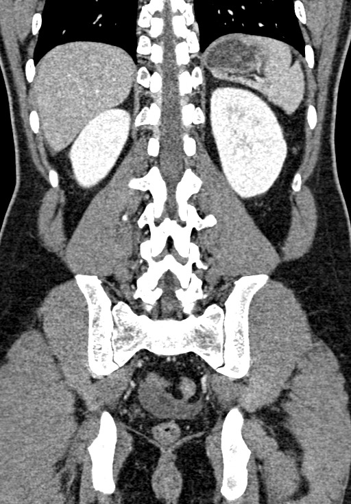 Adhesional small bowel obstruction (Radiopaedia 58900-66131 Coronal C+ portal venous phase 189).jpg