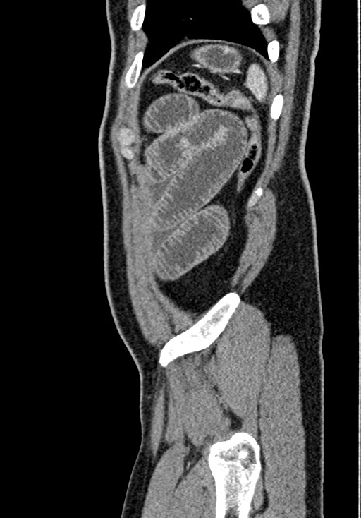 Adhesional small bowel obstruction (Radiopaedia 58900-66131 Sagittal C+ portal venous phase 222).jpg