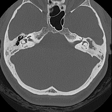 File:Adhesive chronic otitis media (Radiopaedia 14270-14148 Axial bone window 4).jpg