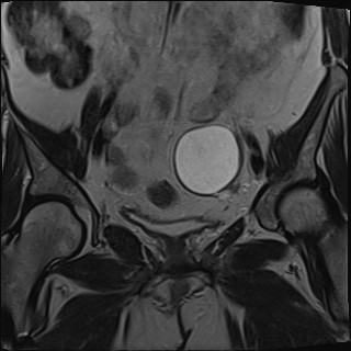 File:Adnexal multilocular cyst (O-RADS US 3- O-RADS MRI 3) (Radiopaedia 87426-103754 Coronal T2 14).jpg