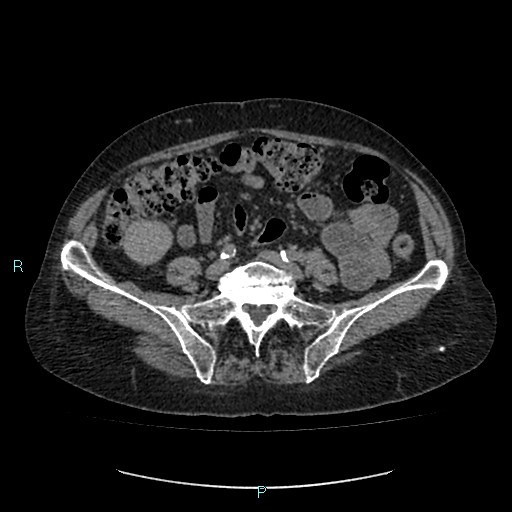 File:Adrenal collision tumor (ACT) (Radiopaedia 48462-53379 Axial non-contrast 41).jpg