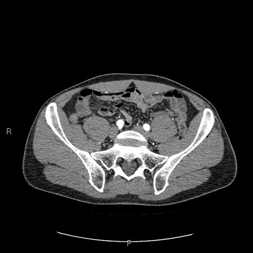 Adrenal cystic lymphangioma (Radiopaedia 83161-97534 Axial C+ arterial phase 71).jpg