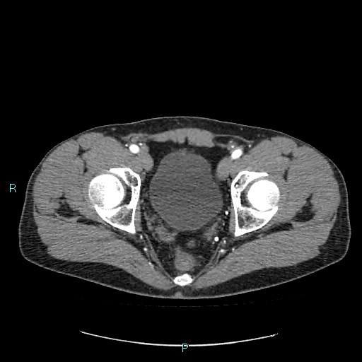 Adrenal cystic lymphangioma (Radiopaedia 83161-97534 Axial C+ arterial phase 91).jpg