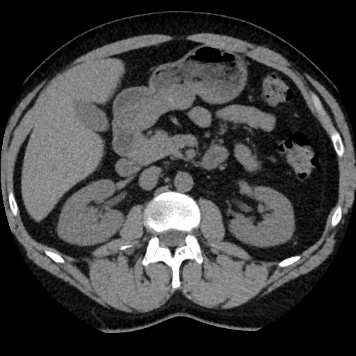 Adrenal gland trauma (Radiopaedia 81351-95079 Axial non-contrast 44).jpg