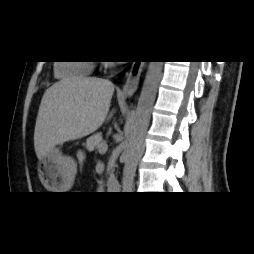 Adrenal gland trauma (Radiopaedia 81351-95079 Sagittal non-contrast 54).jpg