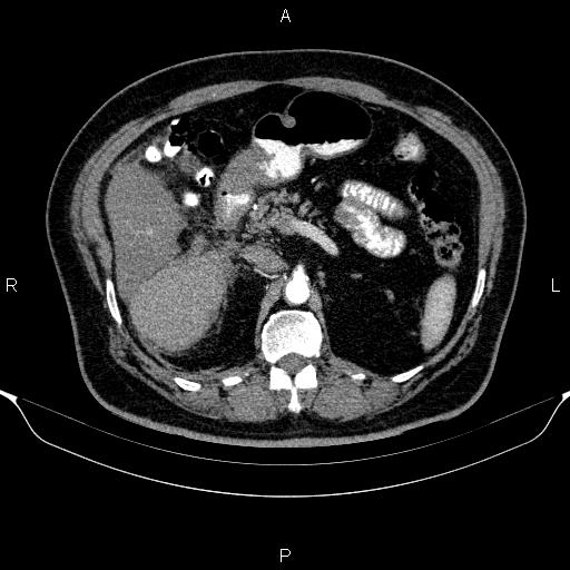 Adrenal hemorrhage (Radiopaedia 62622-70916 Axial C+ arterial phase 134).jpg