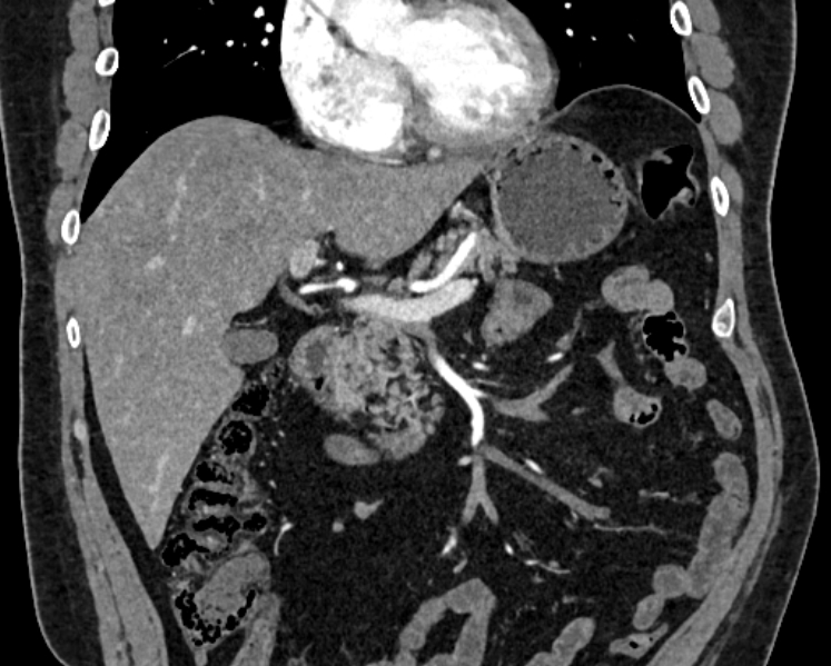 Adrenal metastases (Radiopaedia 73082-83791 Coronal C+ arterial phase 2).jpg