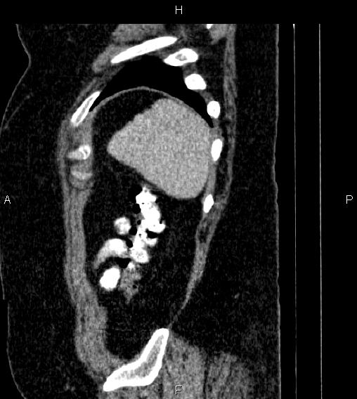 Adrenal myelolipoma (Radiopaedia 84319-99617 Sagittal renal cortical phase 88).jpg