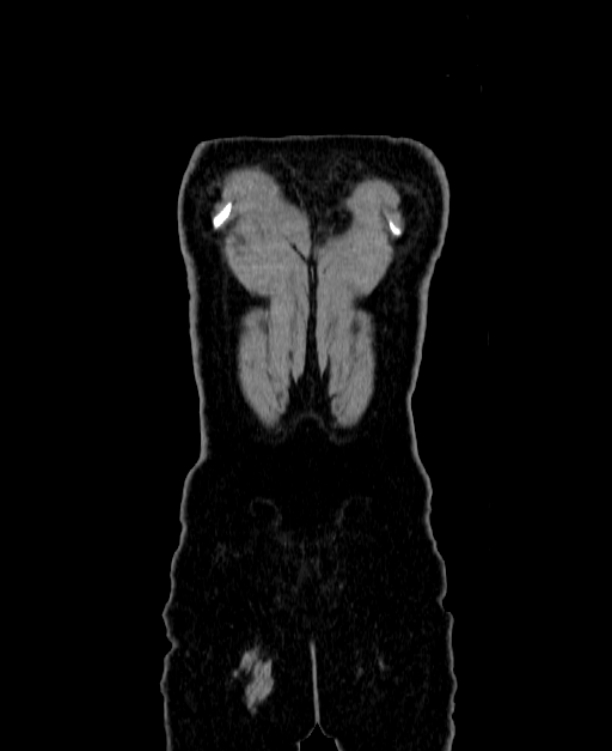 Adrenocortical carcinoma (Radiopaedia 80134-93438 Coronal C+ portal venous phase 166).jpg