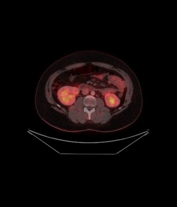 Adrenocortical carcinoma (Radiopaedia 80134-93440 ِAxial 185).jpg