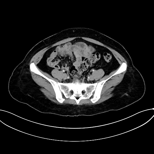Adrenocortical carcinoma (Radiopaedia 87281-103569 Axial C+ portal venous phase 65).jpg