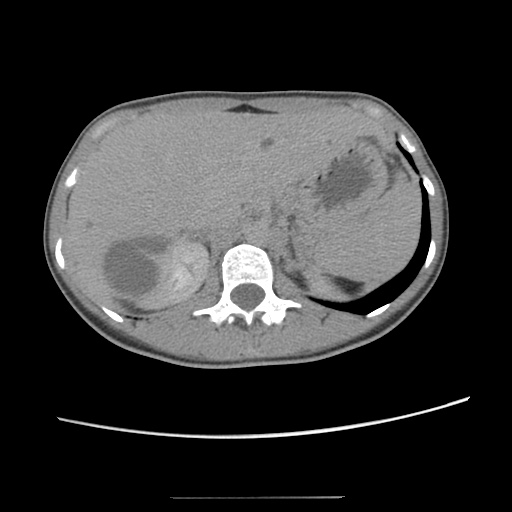 Adult polycystic kidney disease (Radiopaedia 48845-53876 Axial renal excretory phase 28).jpg