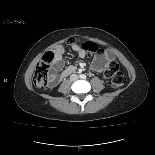 Adult transient intestinal intussusception (Radiopaedia 34853-36310 Axial C+ portal venous phase 51).jpg
