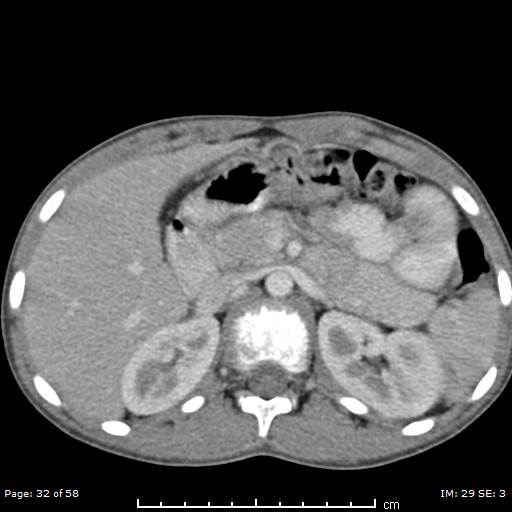 File:Agenesis of the gallbladder (Radiopaedia 55454-61905 B 32).jpg