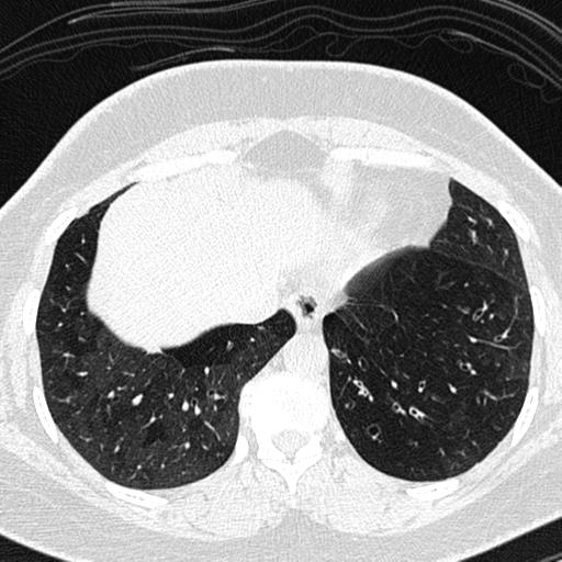 Air trapping in small airway disease (Radiopaedia 61685-69694 Axial lung window 147).jpg