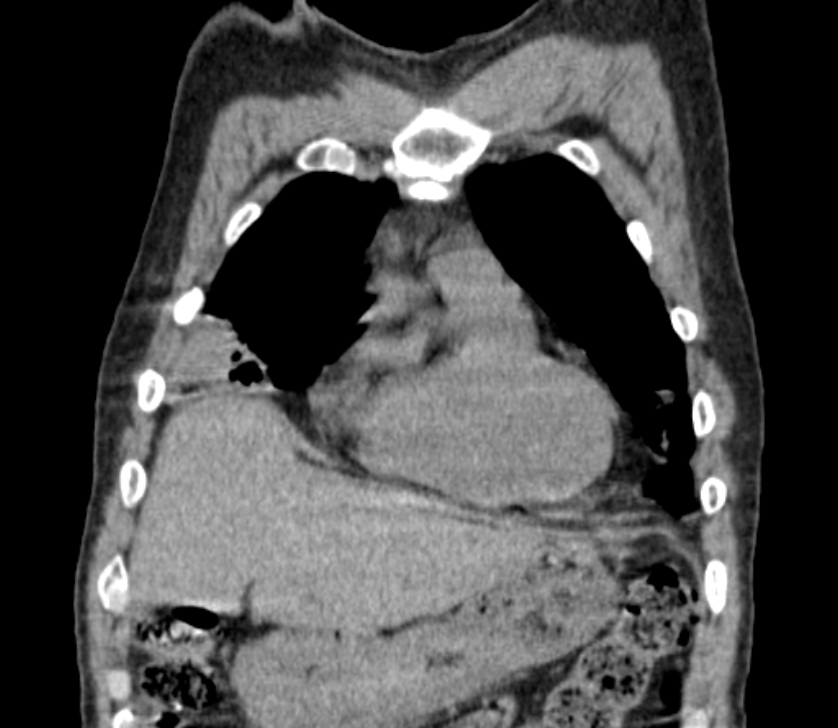 Airway foreign body in adult (Radiopaedia 85907-101779 Coronal liver window 51).jpg