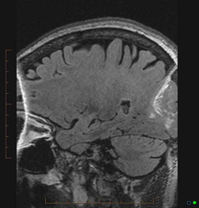 Aliasing artifact causing a spurious cerebellar lesion (Radiopaedia 48783-53810 Sagittal FLAIR 85).jpg