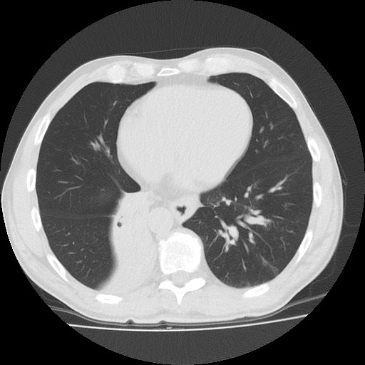 File:Allergic bronchopulmonary aspergillosis (ABPA) (Radiopaedia 60594-68313 Axial lung window 42).jpg