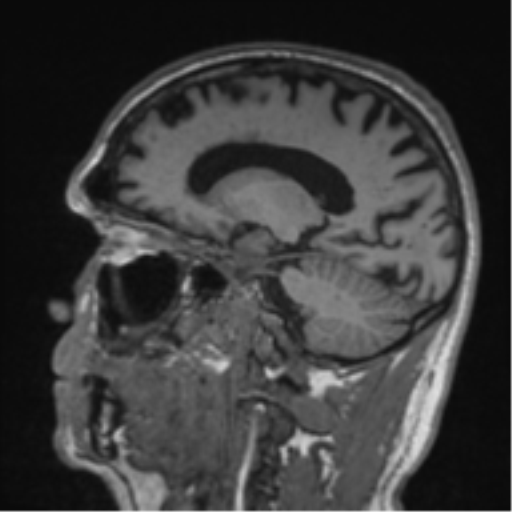 Alzheimer's disease- with Gerstmann syndrome and dressing apraxia (Radiopaedia 54882-61150 Sagittal T1 44).png