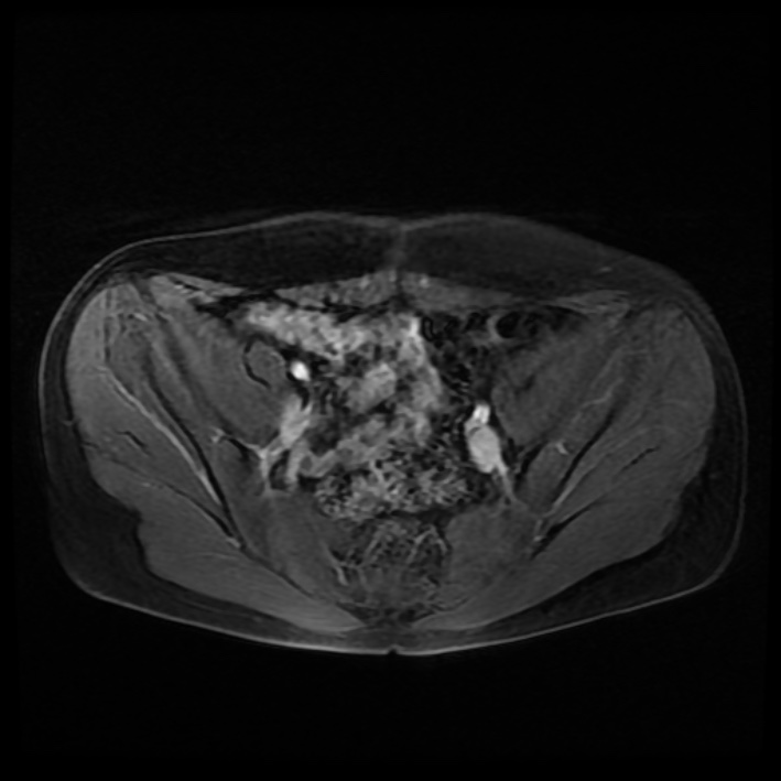 Ambiguous genitalia (Radiopaedia 69686-79643 Axial T1 C+ fat sat 15).jpg
