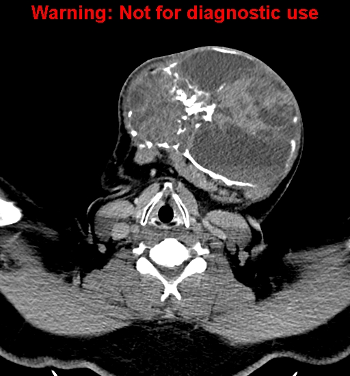 File:Ameloblastoma (Radiopaedia 33126-34164 B 24).jpg