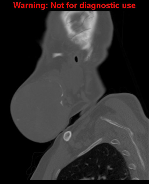 Ameloblastoma (Radiopaedia 33126-34164 Sagittal bone window 17).jpg