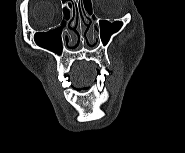 Ameloblastoma (Radiopaedia 51921-57766 Coronal bone window 40).jpg