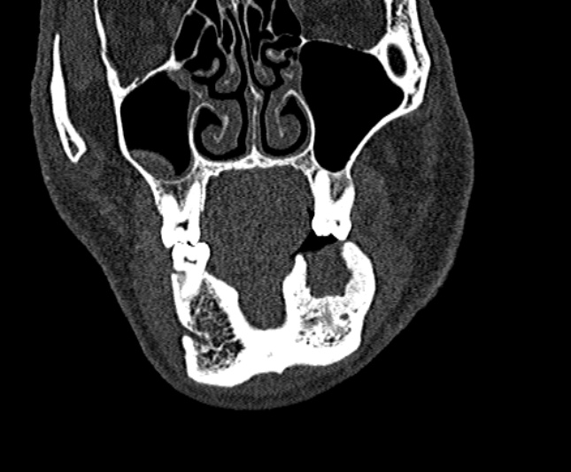Ameloblastoma (Radiopaedia 51921-57766 Coronal bone window 62).jpg