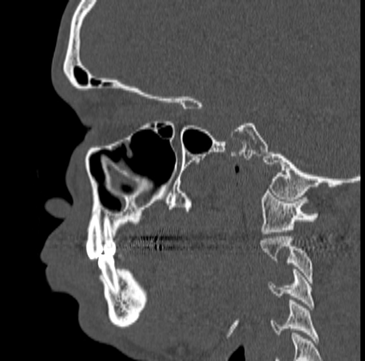 Ameloblastoma (Radiopaedia 77750-89997 Sagittal bone window 19).jpg