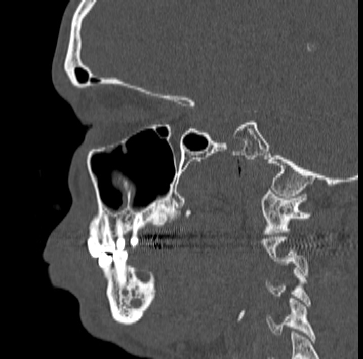 Ameloblastoma (Radiopaedia 77750-89997 Sagittal bone window 25).jpg