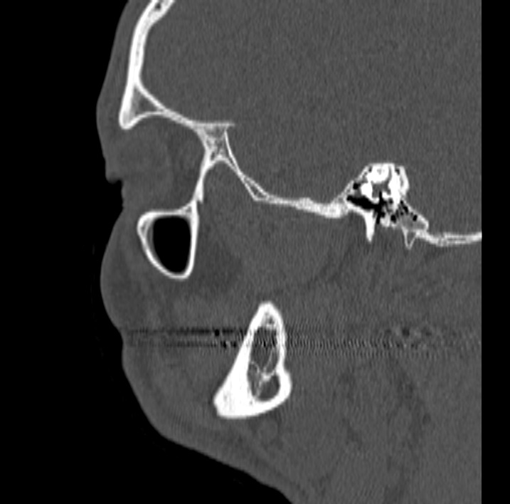 Ameloblastoma (Radiopaedia 77750-89997 Sagittal bone window 80).jpg