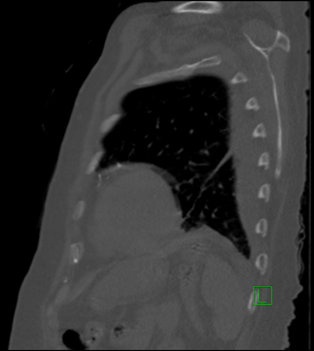 Amiodarone deposition in the liver (Radiopaedia 77587-89780 Sagittal bone window 25).jpg