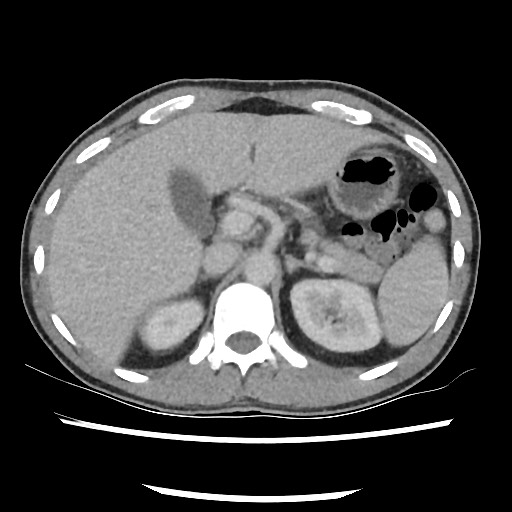 Amoebic liver abscesses (Radiopaedia 55536-62010 A 29).jpg