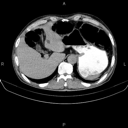 Ampullary adenocarcinoma (Radiopaedia 86093-102032 Axial C+ delayed 19).jpg