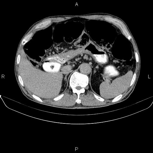 Ampullary adenocarcinoma (Radiopaedia 86093-102032 Axial C+ delayed 26).jpg
