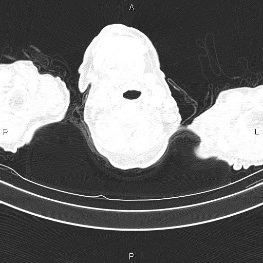 Ampullary adenocarcinoma (Radiopaedia 86093-102033 Axial lung window 2).jpg
