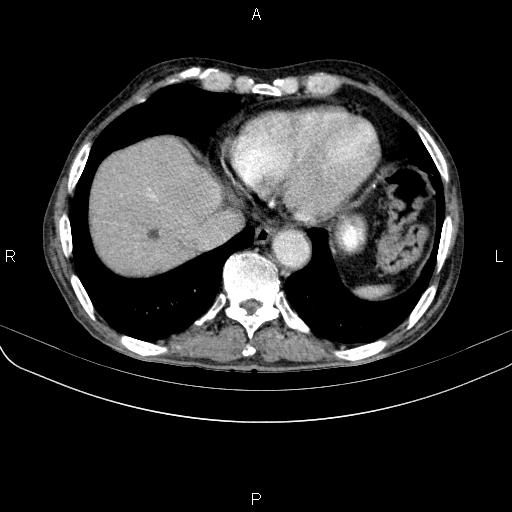 Ampullary adenocarcinoma (Radiopaedia 86093-102033 B 46).jpg