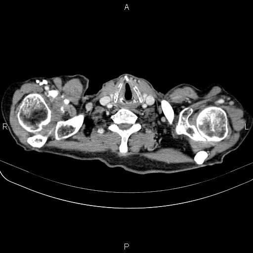 File:Ampullary adenocarcinoma (Radiopaedia 86093-102033 B 8).jpg