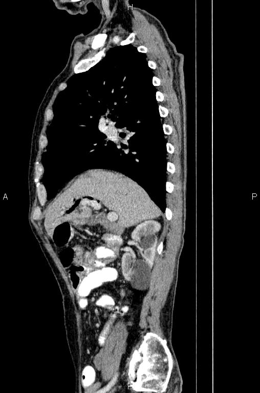 Ampullary adenocarcinoma (Radiopaedia 86093-102033 E 30).jpg