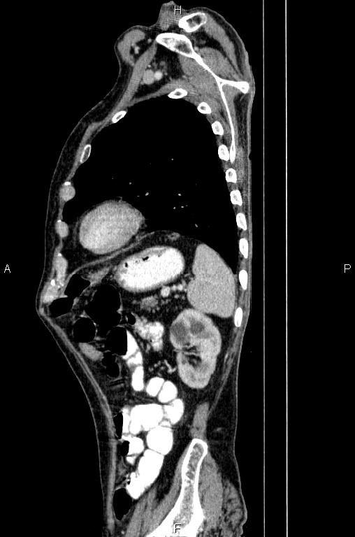 Ampullary adenocarcinoma (Radiopaedia 86093-102033 E 73).jpg