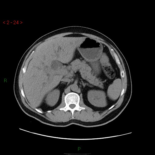 File:Ampullary carcinoma (Radiopaedia 56396-63056 Axial non-contrast 16).jpg