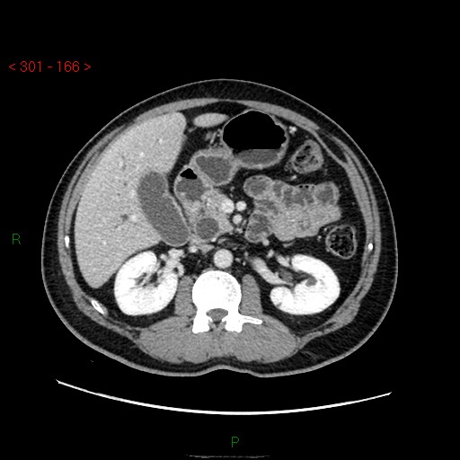 Ampullary carcinoma (Radiopaedia 56396-63056 C 38).jpg