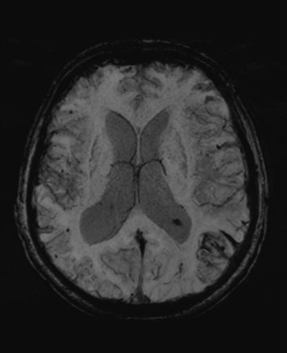 File:Amyloid angiopathy with inflammation (Radiopaedia 30360-31002 Axial SWI MIP 32).jpg