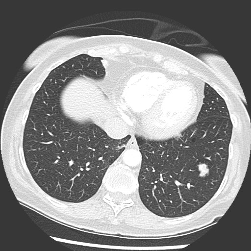 Amyloidosis - bronchial and diffuse nodular pulmonary involvement (Radiopaedia 60156-67745 Axial lung window 64).jpg