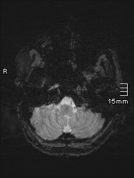 Amyotrophic lateral sclerosis (Radiopaedia 70821-81017 Axial SWI 2).jpg