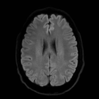 File:Amyotrophic lateral sclerosis (Radiopaedia 87352-103658 Axial DWI 46).jpg