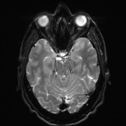 File:Amyotrophic lateral sclerosis (Radiopaedia 87352-103658 Axial DWI 9).jpg