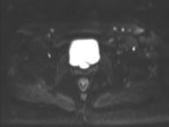 Anal adenocarcinoma - tumor regression grade 1 (Radiopaedia 31358-32101 Axial DWI 13).jpg