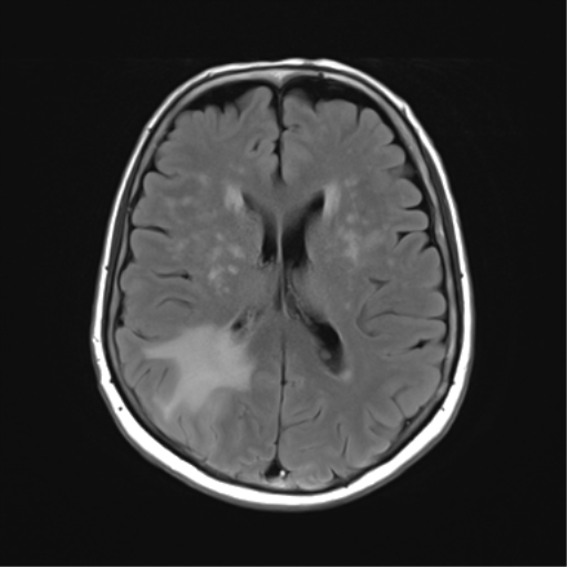 File:Anaplastic astrocytoma (Radiopaedia 86943-103160 Axial FLAIR 17).png