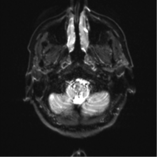 File:Anaplastic astrocytoma - thalamic glioma (Radiopaedia 59709-67115 Axial DWI 3).png